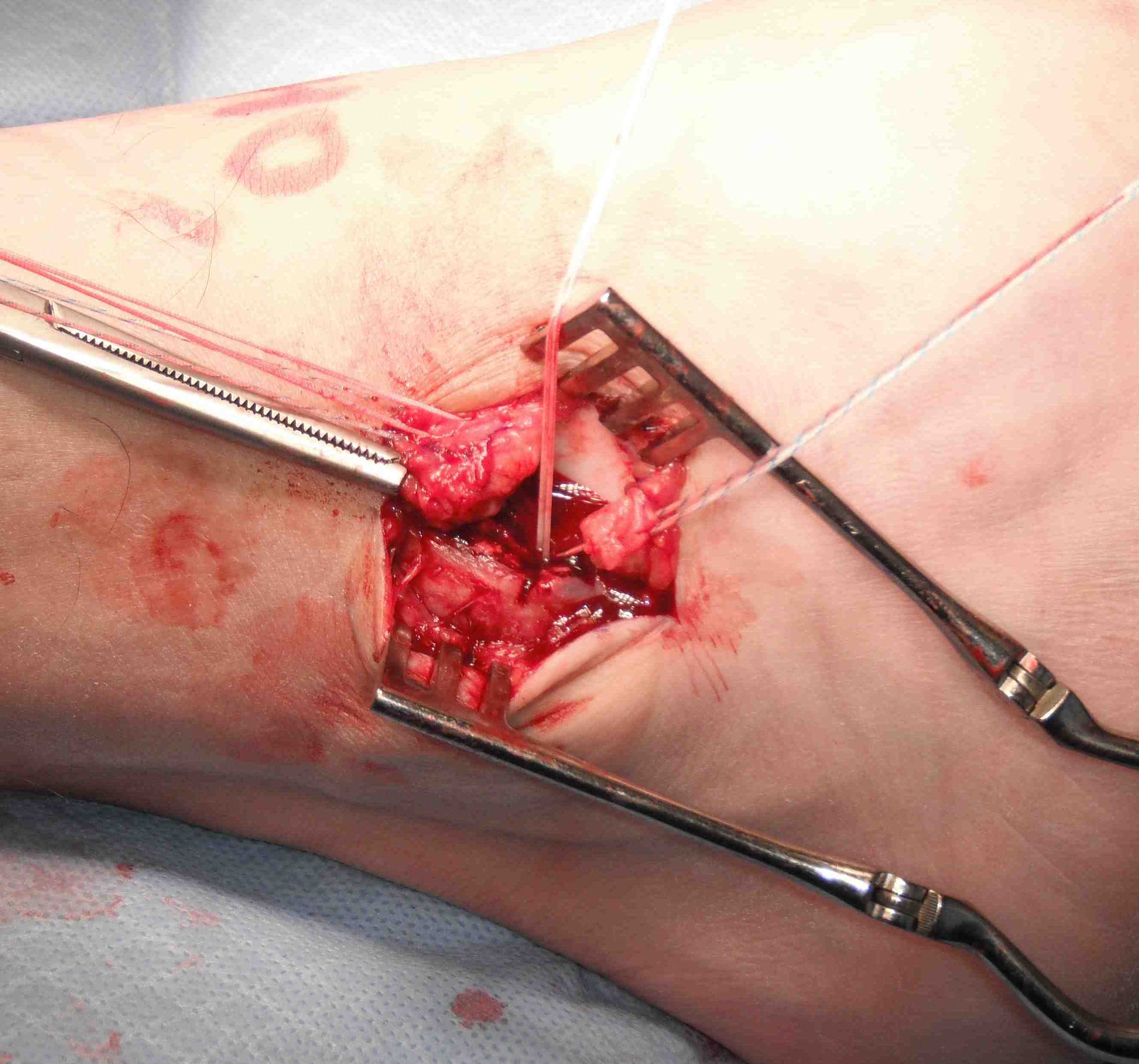 2 Sutures Inferior Flap